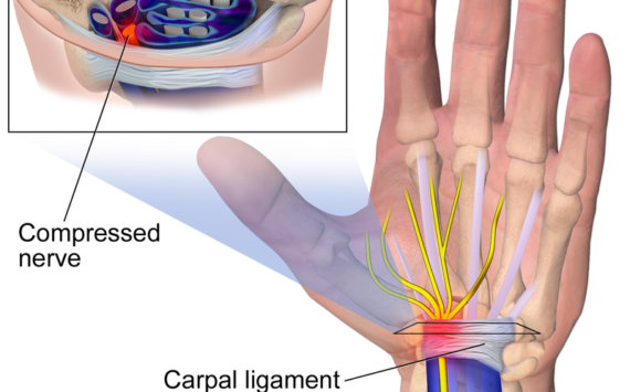 Carpal Tunnel Syndrome