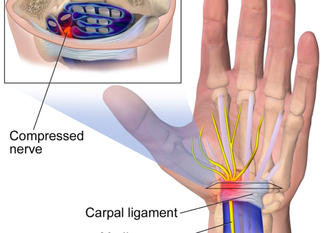 Carpal Tunnel Syndrome