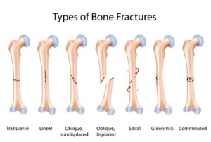 comminuted fracture 